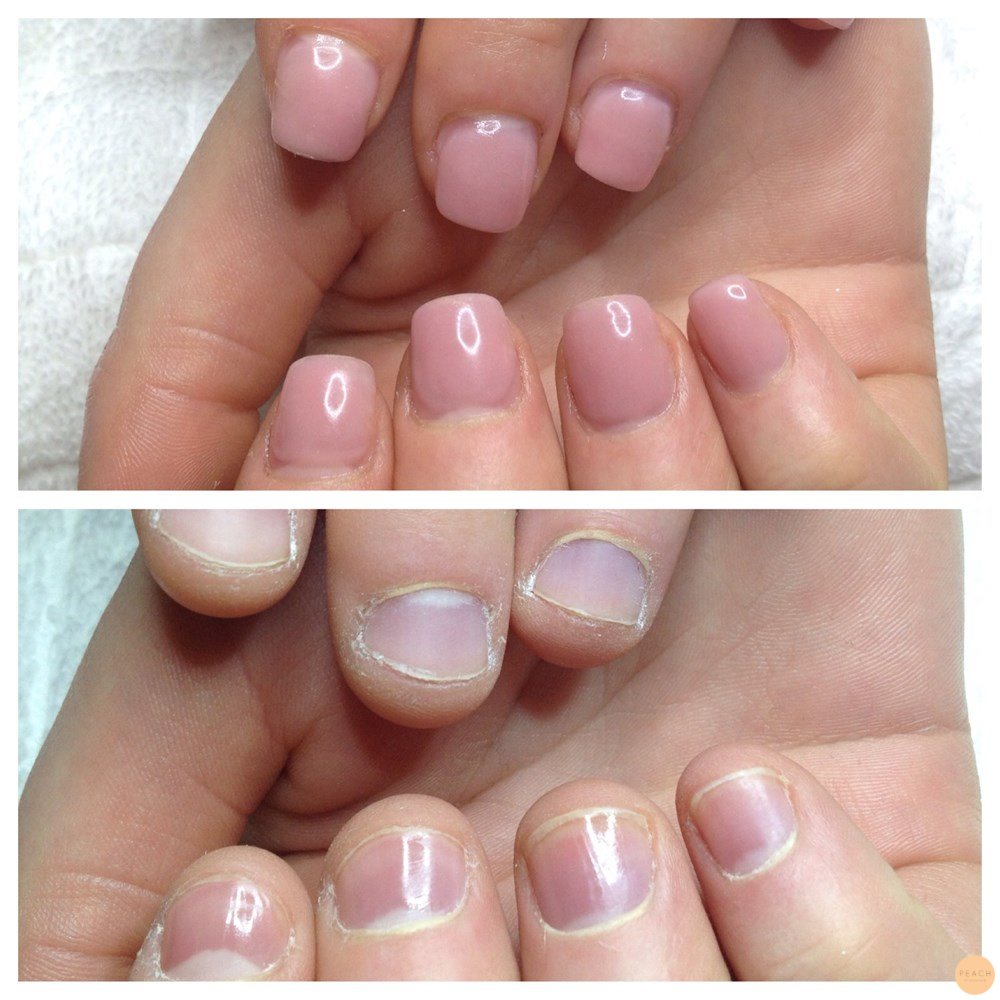 Förlängning nagelbitare