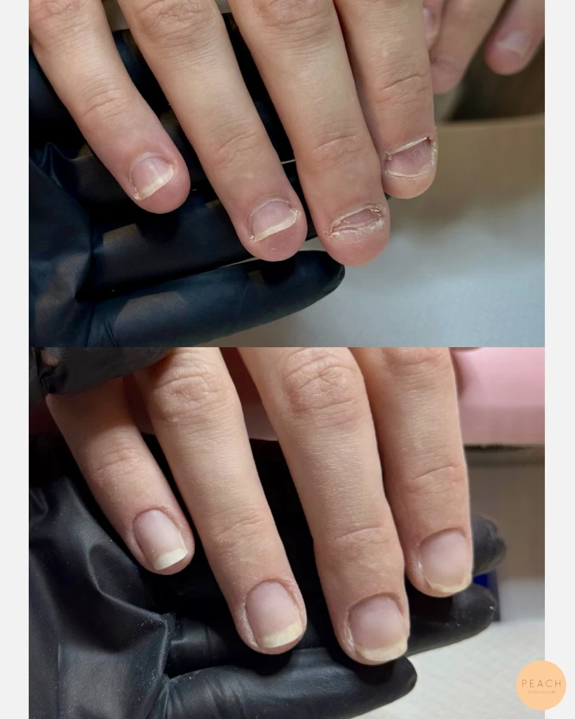 Nagelbitning behandling