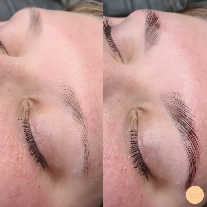 Browlift före och efter
