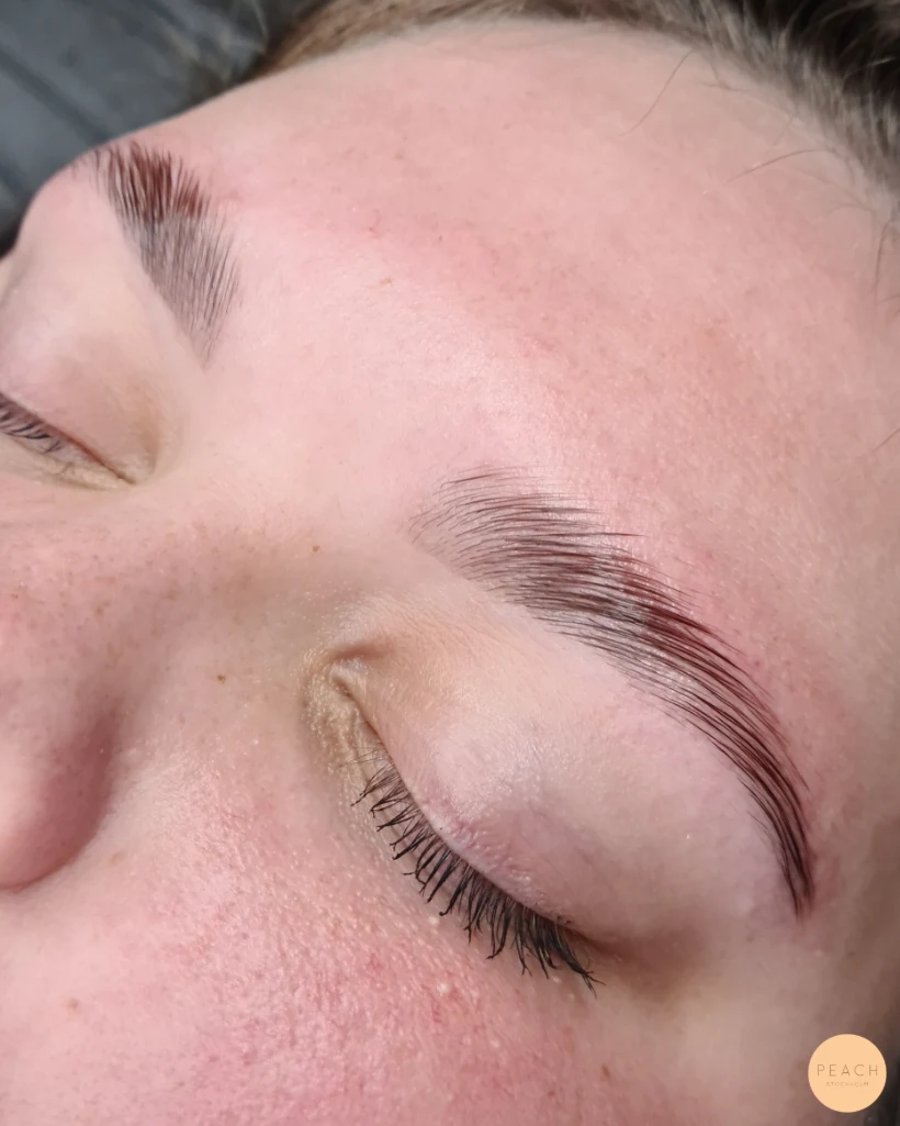 Browlift före och efter