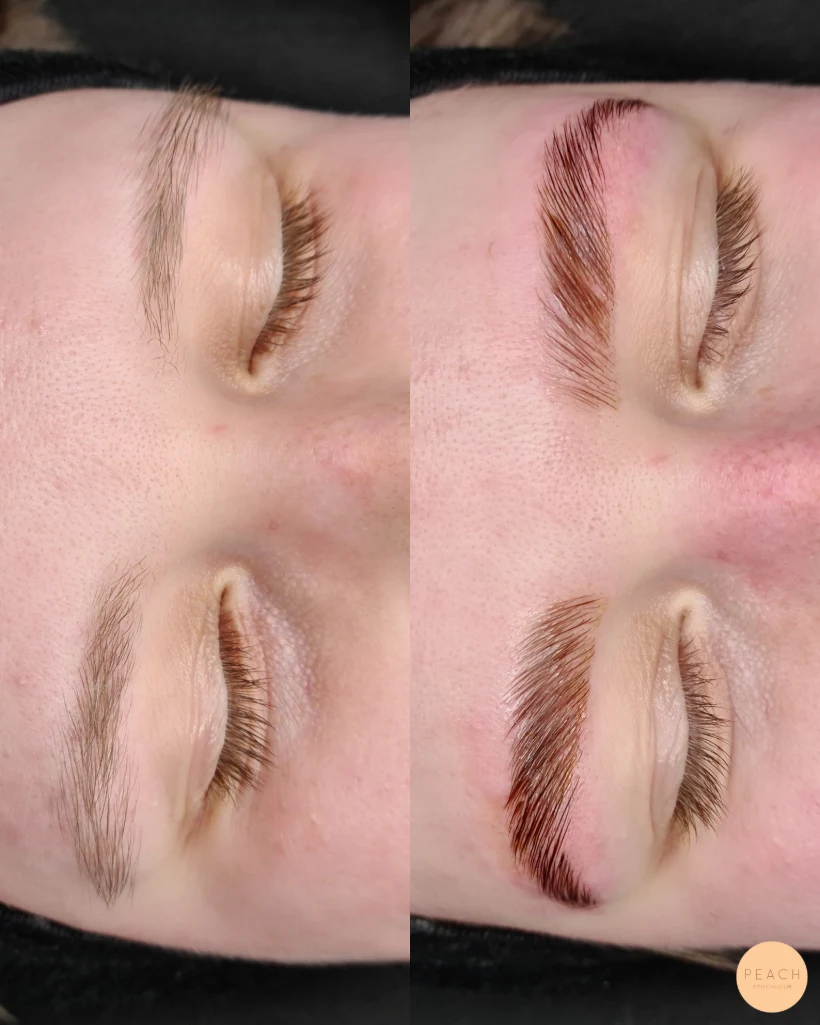 Browlift
