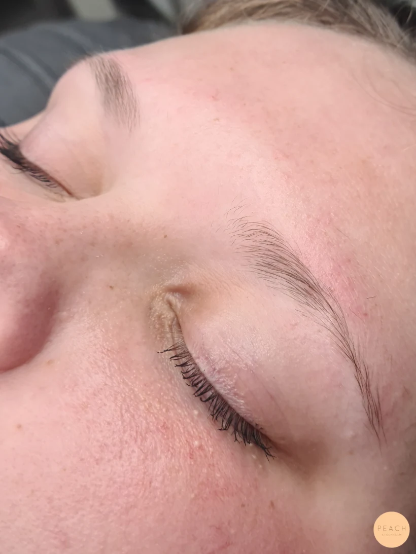 Browlift före och efter