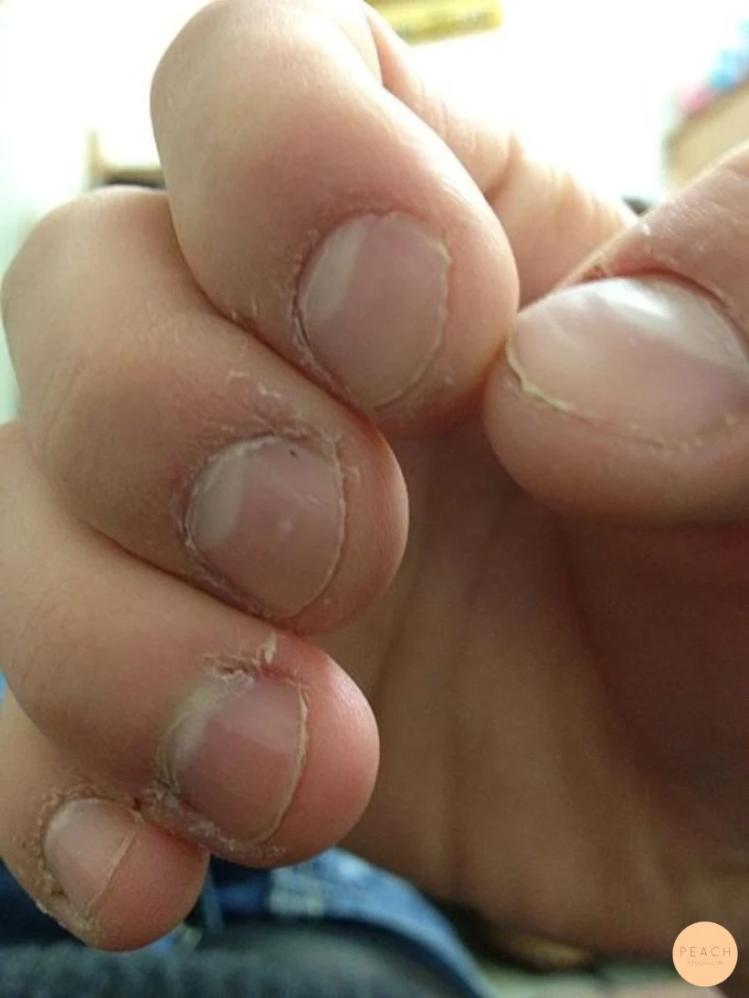 Nagelbitare? Vi hjälper dig!